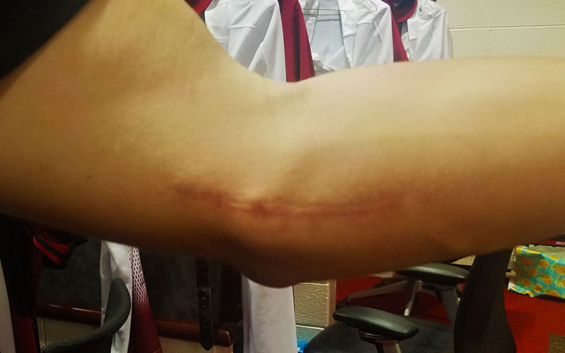 Diamondbacks' pitcher Patrick Corbin shows the scar his 2014 Tommy John surgery left on his left elbow.  (Photo by Trisha Garcia/Cronkite News)