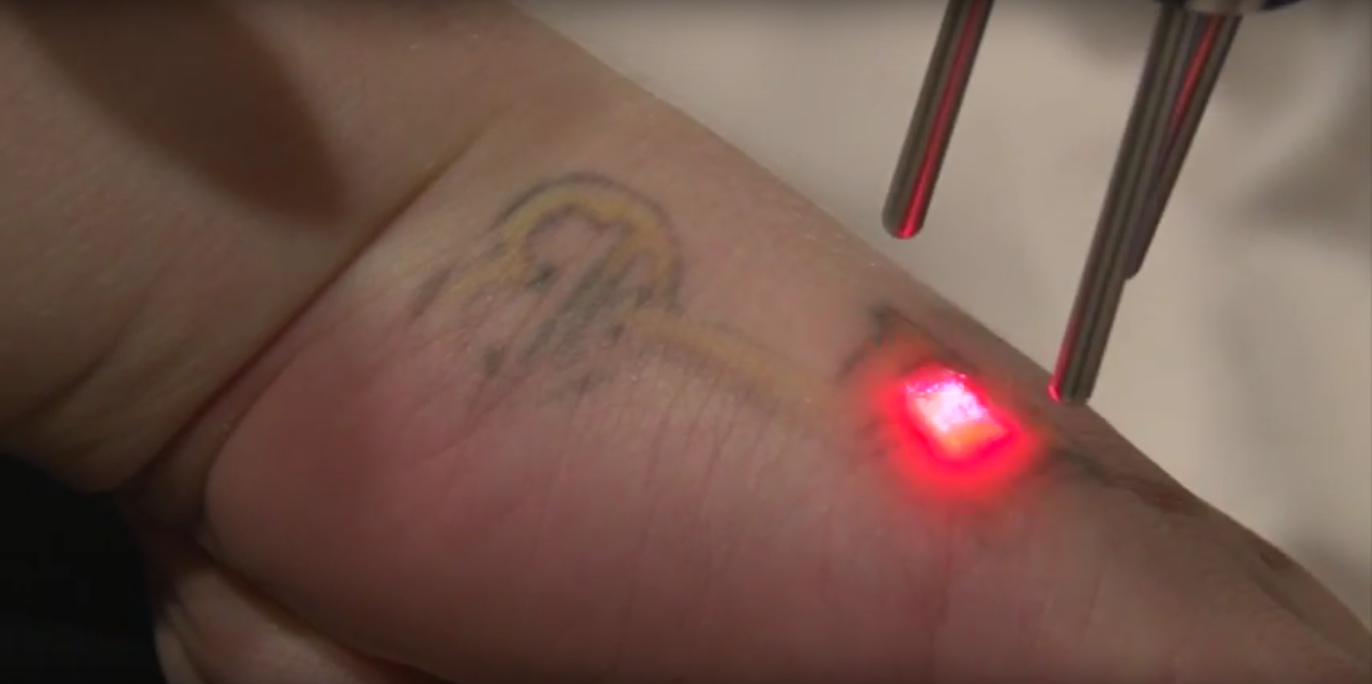 man gets tattoo lasered off