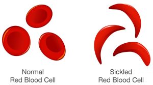 The difference of Normal red blood cell and sickle cell. Illustration about medical. (Photo courtesy of the CDC)
